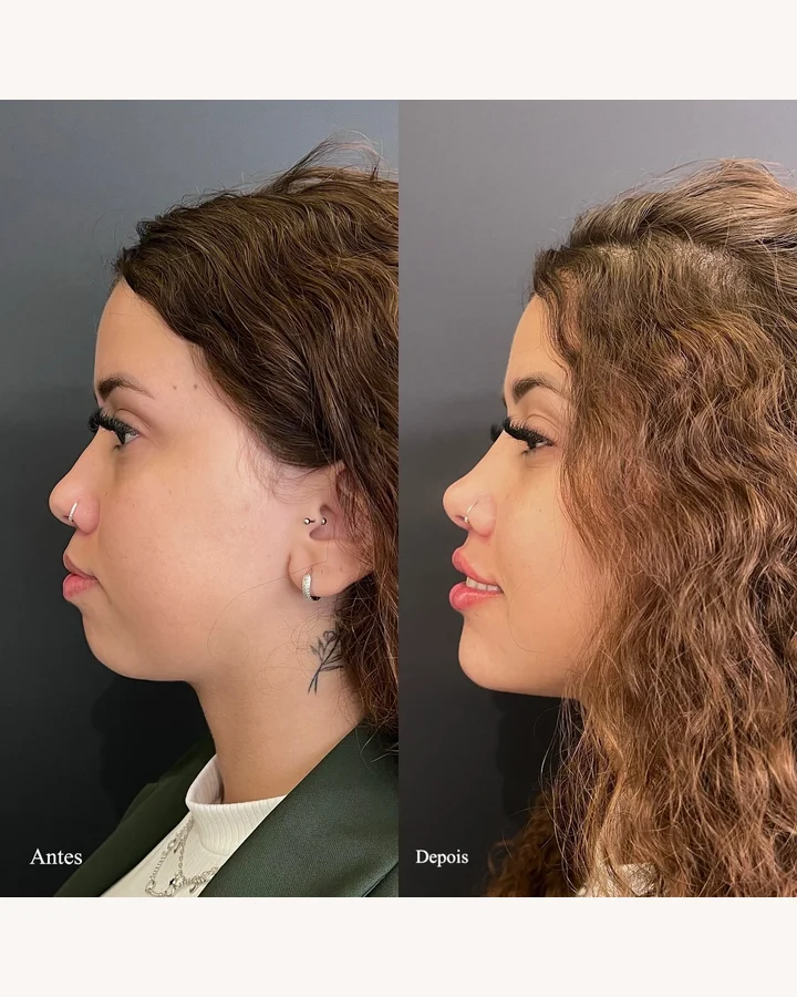 Resultado antes e depois 2